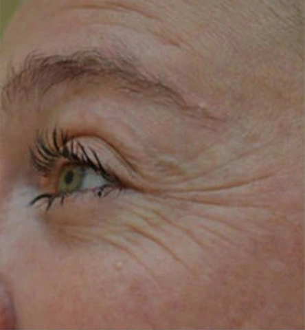 REJUVA UltraRF Skin Tightening and Fat Loss