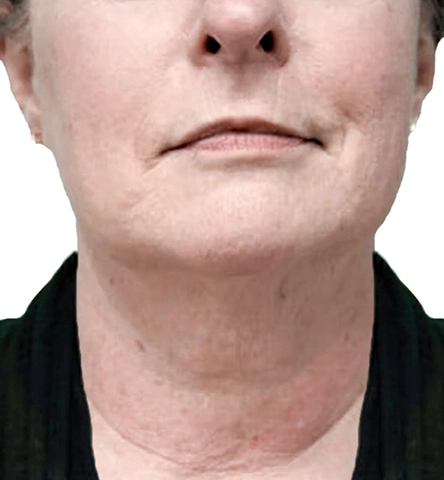 REJUVA UltraRF Skin Tightening and Fat Loss