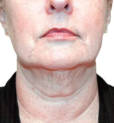 REJUVA UltraRF Skin Tightening and Fat Loss