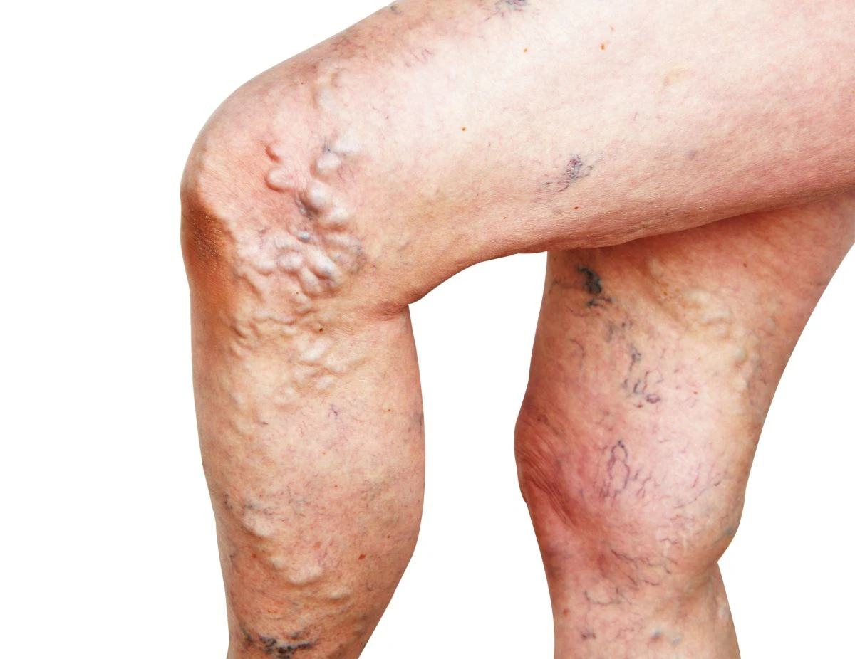 Varicose Vein Treatment