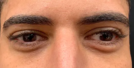 REJUVA Advanced Fillers in Venice, FL at Rejuva Dermatology & Vein Center