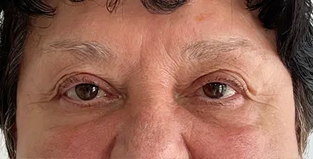 REJUVA Advanced Fillers in Venice, FL at Rejuva Dermatology & Vein Center