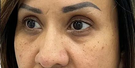 REJUVA Advanced Fillers in Venice, FL at Rejuva Dermatology & Vein Center