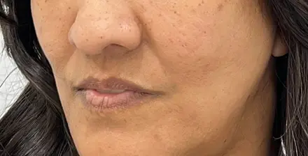 REJUVA Advanced Fillers in Venice, FL at Rejuva Dermatology & Vein Center