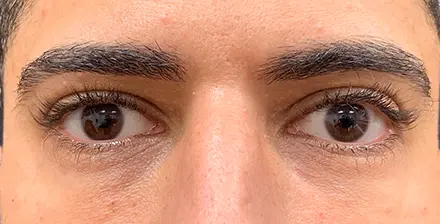 REJUVA Advanced Fillers in Venice, FL at Rejuva Dermatology & Vein Center