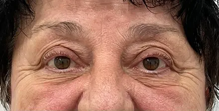 REJUVA Advanced Fillers in Venice, FL at Rejuva Dermatology & Vein Center