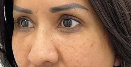 REJUVA Advanced Fillers in Venice, FL at Rejuva Dermatology & Vein Center