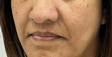 REJUVA Advanced Fillers in Venice, FL at Rejuva Dermatology & Vein Center