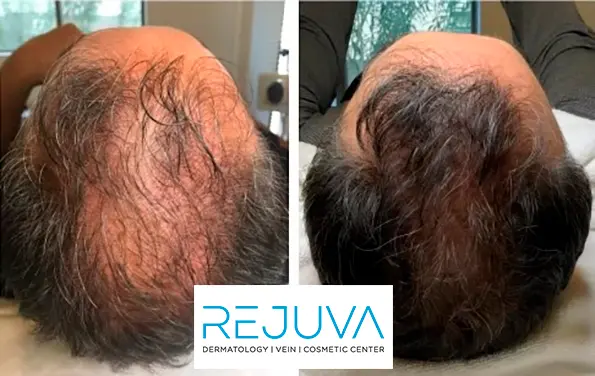 Hair Transplantation Rejuva