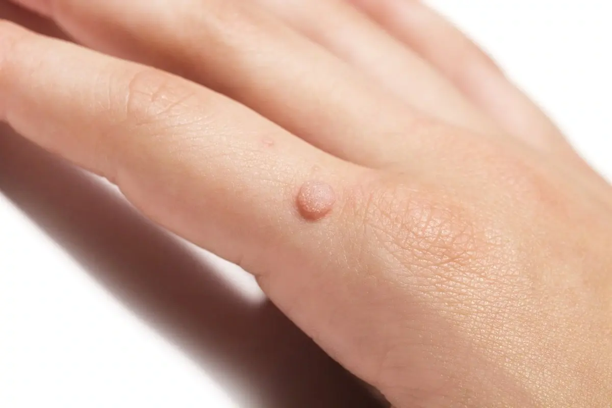 Warts Treatment in Venice, FL at Rejuva Dermatology & Vein Center