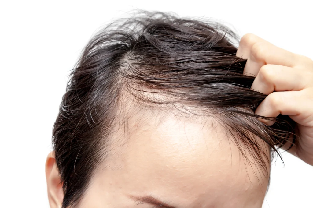 Hair Loss in Men and Women: When Medical Evaluation Matters