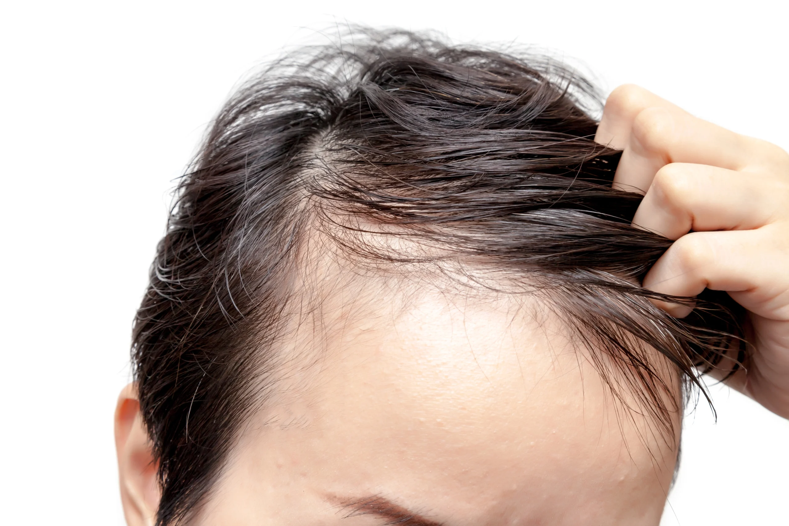 Hair Loss in Men and Women: When Medical Evaluation Matters