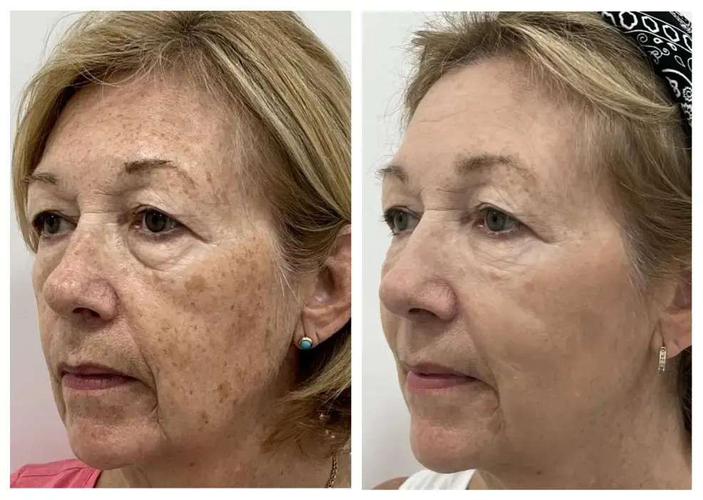 What Is the Best Laser for Sun Damage, Brown Spots, and Uneven Tone?
