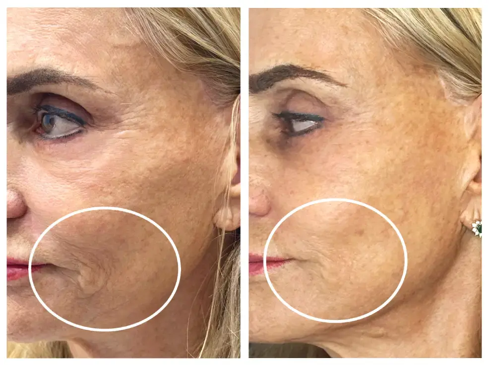 What Is the Best Nonsurgical Treatment for Sagging Jowls?