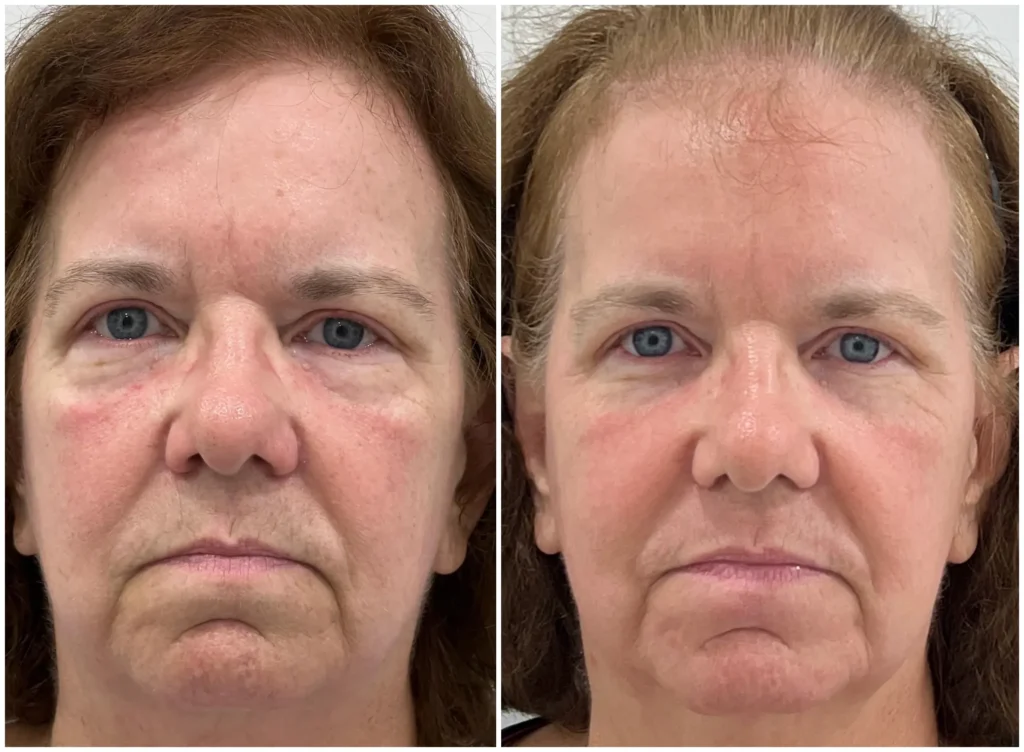Wrinkles or Sagging Skin? Lasers vs HIFU vs RF Microneedling