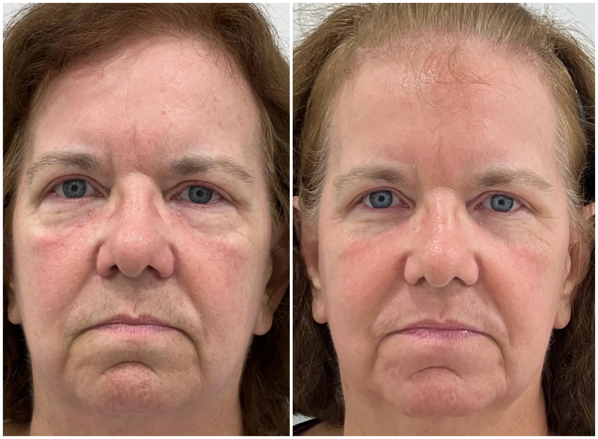 Wrinkles or Sagging Skin? Lasers vs HIFU vs RF Microneedling