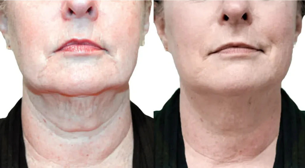 What Is the Best Nonsurgical Treatment for a Sagging Neck?
