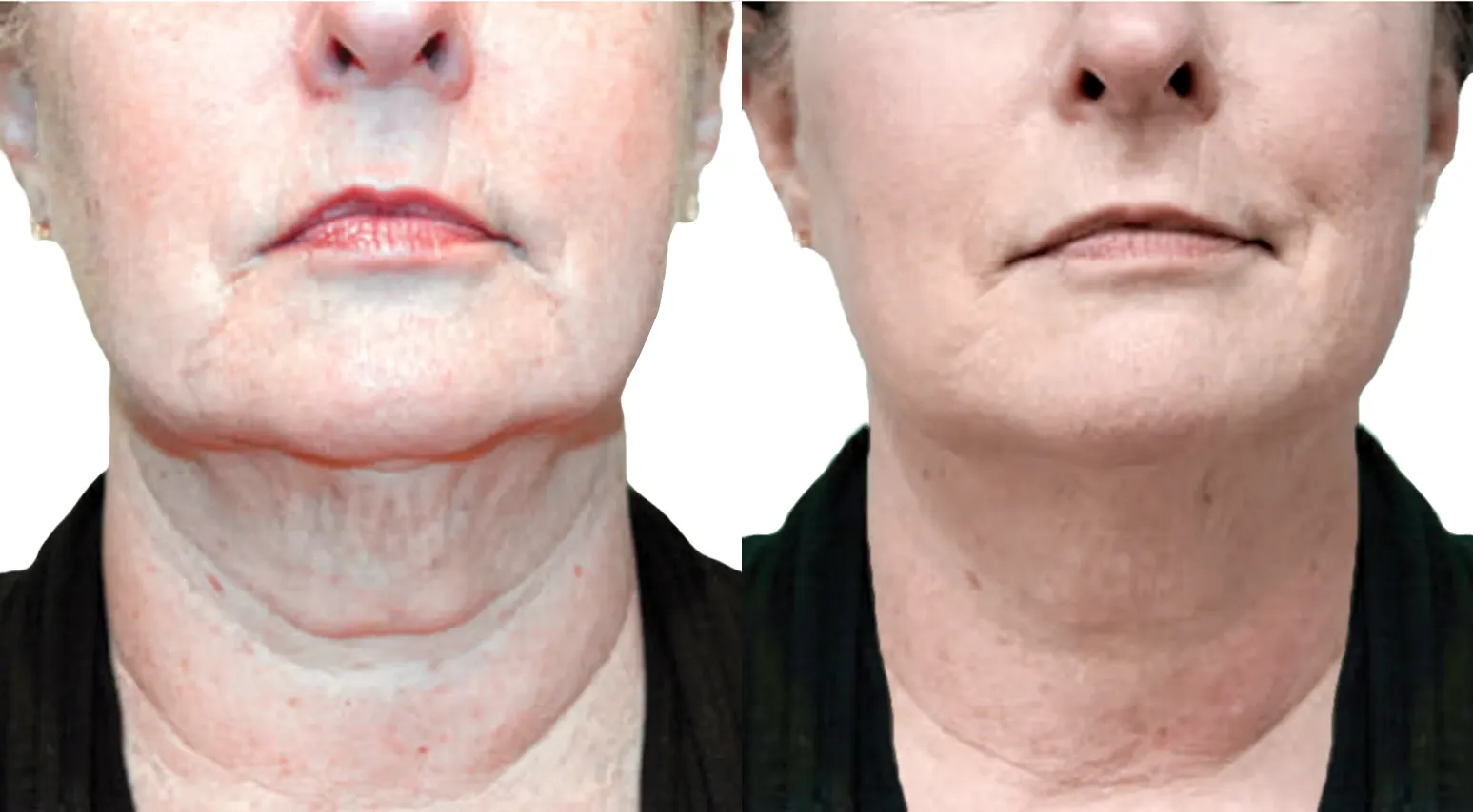 What Is the Best Nonsurgical Treatment for a Sagging Neck?