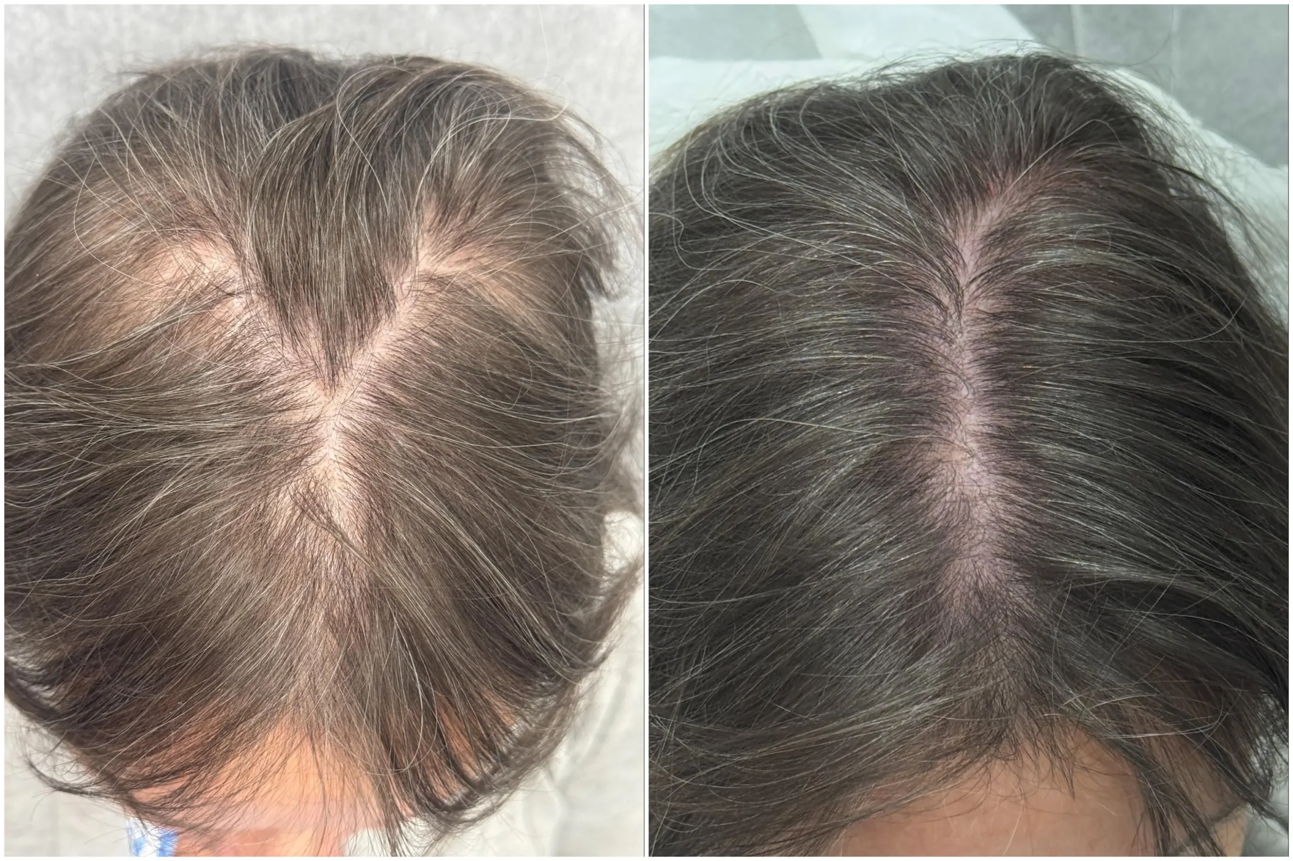 PRP, PRF, Exosomes, or Laser: Which Is Best for Thinning Hair?
