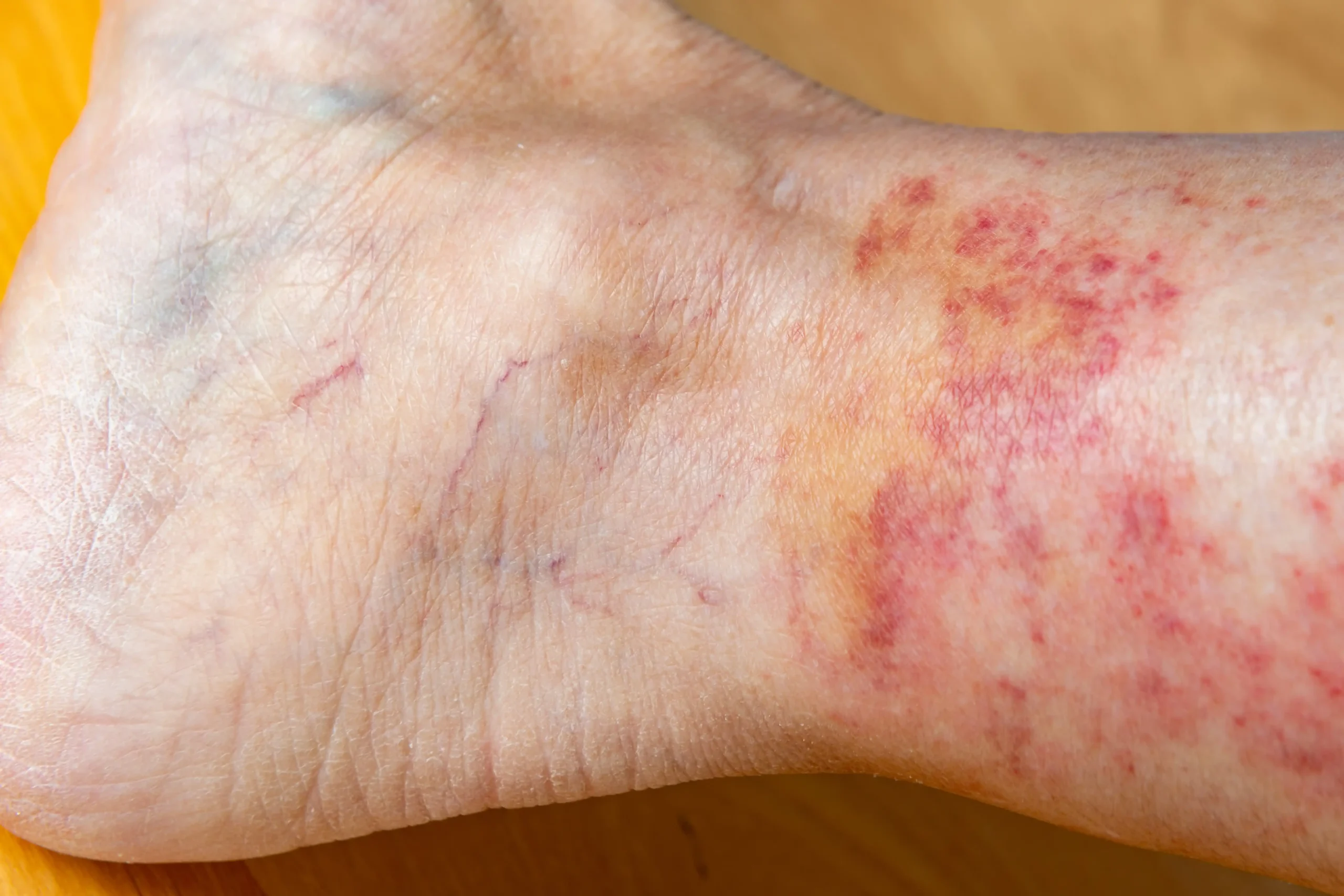 I’m Over 75 With Skin Cancer: Mohs, Radiation, or Can I Watch It?