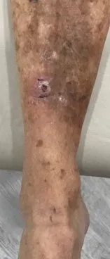 Skin Cancer Treatment
