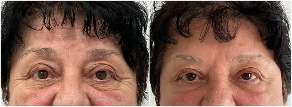 What Is the Best Treatment for Crepey Eyelids and Eye Wrinkles?