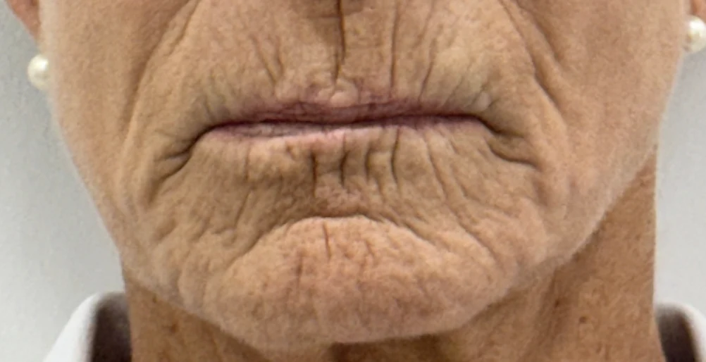 What Is the Best Treatment for Vertical Lip Lines and Mouth Wrinkles?