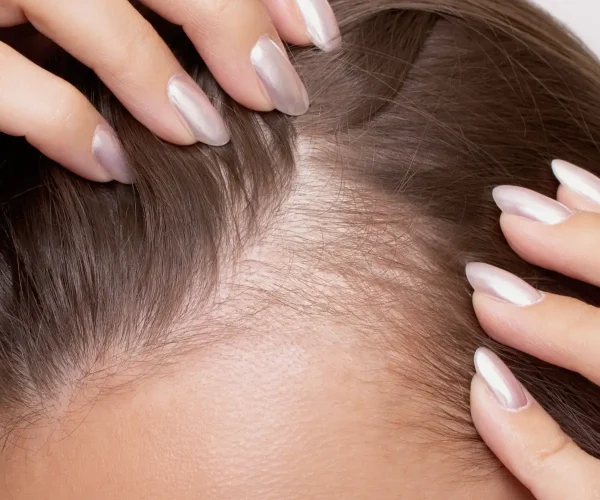 Hair Loss Treatment in Venice, FL | Rejuva Dermatology